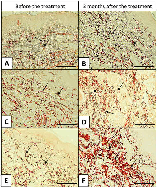 Histologisches Hautbild der Haut nach Mesotherapie mit Schneckenschleim – elastische Fasern, Orcein-Färbung, 40x