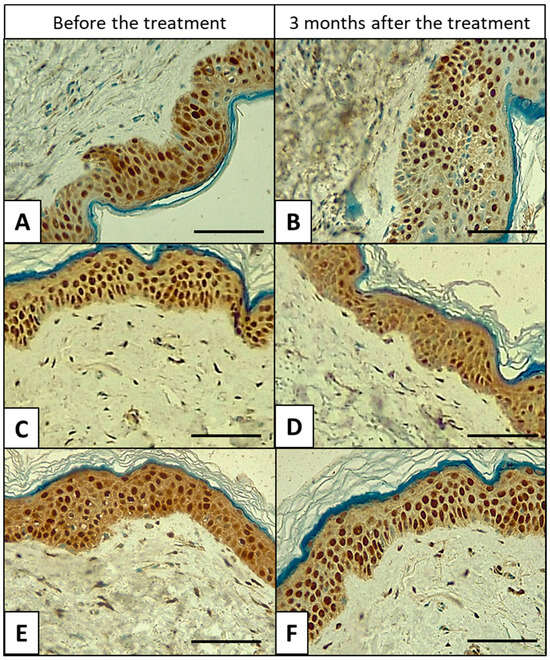 Immunhistochemische PCNA-Expression in menschlicher Haut vor und nach 3 Monaten Mesotherapie mit 98,2 % Schneckenschleim (Mikronadel und nadelfrei), epidermale Proliferation, 40×